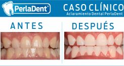 Aclaramiento Dental (1)