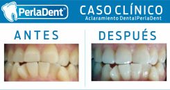 Aclaramiento Dental (2)
