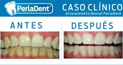Aclaramiento Dental (3)