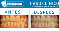 Aclaramiento Dental (4)