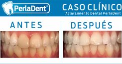 Aclaramiento Dental (5)