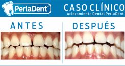 Aclaramiento Dental (6)