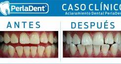 Aclaramiento Dental (7)
