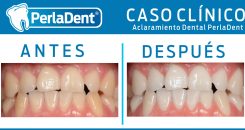 Aclaramiento Dental (9)